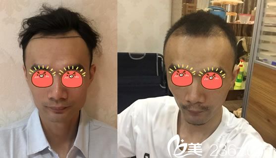 姚寶林給男士種植發(fā)際線案例 姚寶林給男士種植發(fā)際線案例