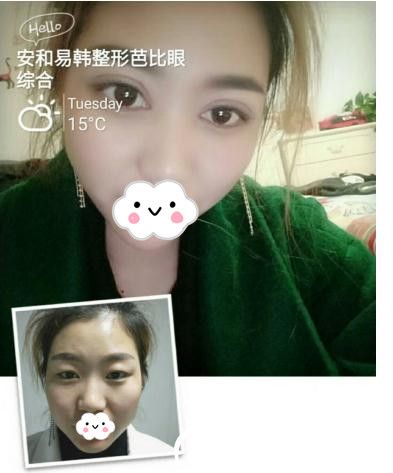 何黎院長芭比雙眼皮案例 何黎院長芭比雙眼皮案例