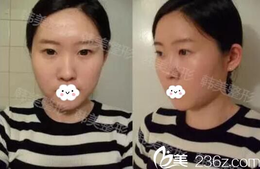 注射隆鼻術(shù)前照片 注射隆鼻術(shù)前照片