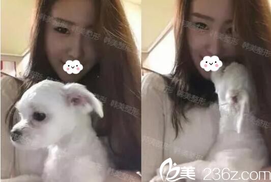 在韓美做玻尿酸隆鼻后的效果 在韓美做玻尿酸隆鼻后的效果