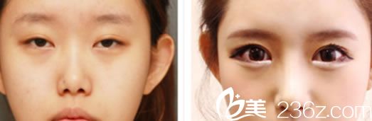 雙眼皮和隆鼻可以一起做嗎