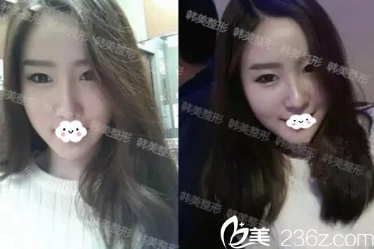 玻尿酸隆鼻術(shù)后一個(gè)月 玻尿酸隆鼻術(shù)后一個(gè)月