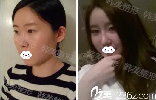 小護(hù)士在達(dá)州韓美做了玻尿酸隆鼻后恢復(fù)過(guò)程及術(shù)后對(duì)比圖反饋