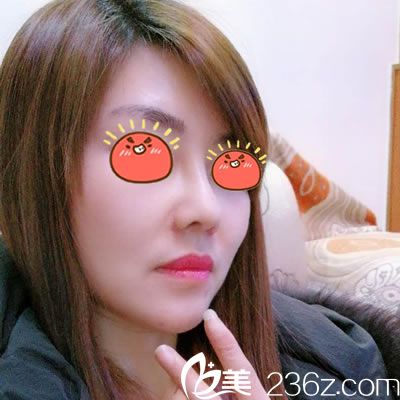 25歲因?yàn)樗菃栴}一直不敢相親,在美容做了肋軟骨綜合隆鼻恢復(fù)自信