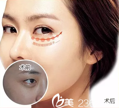 在常州博仕做去眼袋案例