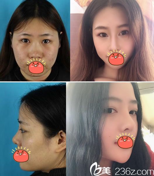 寧波雅韓龔濤院長(zhǎng)隆鼻案例 寧波雅韓龔濤院長(zhǎng)隆鼻案例