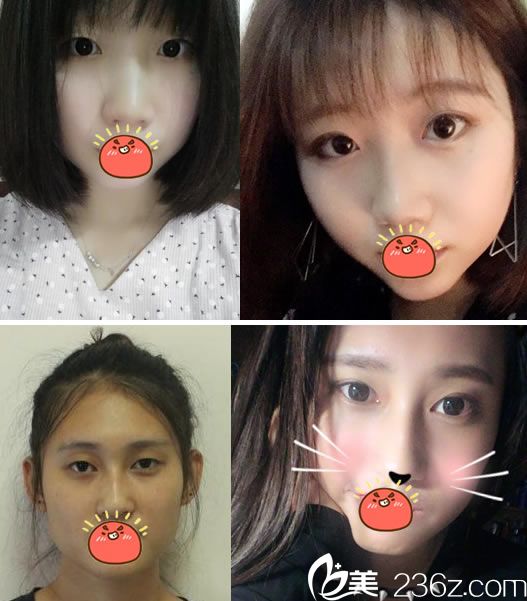 寧波雅韓劉成林院長(zhǎng)割雙眼皮案例 寧波雅韓劉成林院長(zhǎng)割雙眼皮案例