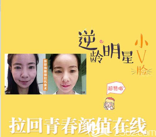 贛州星鉑麗整形PPDO線雕提升，韓式技術，6D全面部提升優(yōu)惠在線預約附案例