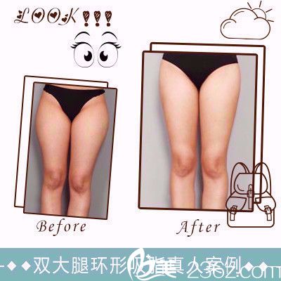 雅芳亞整形醫(yī)院大腿環(huán)吸案例 雅芳亞整形醫(yī)院大腿環(huán)吸案例