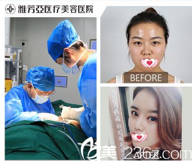 雅芳亞整形醫(yī)院做肋軟骨隆鼻案例 雅芳亞整形醫(yī)院做肋軟骨隆鼻案例