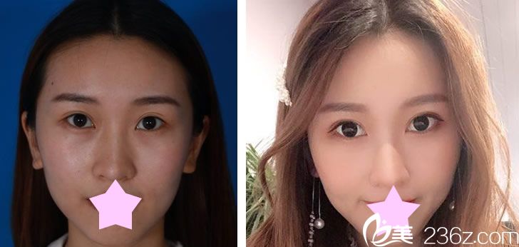 沈秉輝院長(zhǎng)眼綜合+全切雙眼皮效果對(duì)比圖 沈秉輝院長(zhǎng)眼綜合+全切雙眼皮效果對(duì)比圖