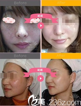 寧波雅韓張紅霞激光祛斑案例 寧波雅韓張紅霞激光祛斑案例
