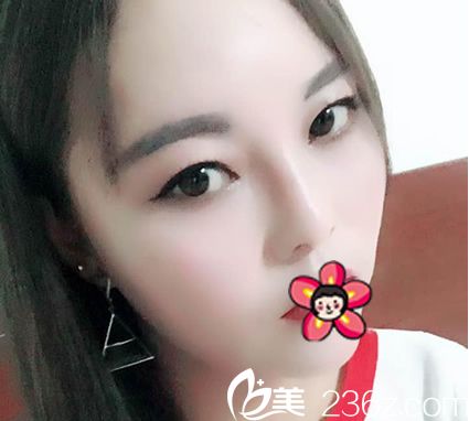 天生面部凹陷,與寧波雅韓劉成林院長(zhǎng)溝通多次才確定做自體脂肪填充手術(shù),效果出來很不錯(cuò)喲