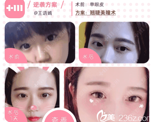 衡陽雅美的翹睫美瞳術(shù)真人案例