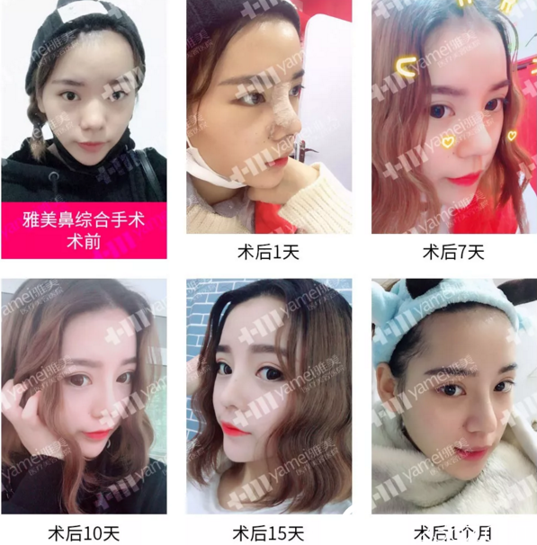 衡陽雅美鼻綜合真人案例