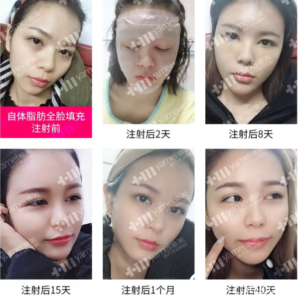 衡陽雅美自體脂肪全臉填充注射真人案例