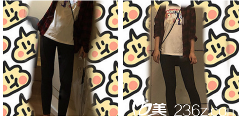 廣州韓妃于洪瑞大腿吸脂術后15天 廣州韓妃于洪瑞大腿吸脂術后15天