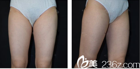 廣州韓妃吸脂案例術前照片 廣州韓妃吸脂案例術前照片