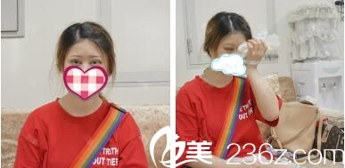 切開雙眼皮術(shù)后即刻冰敷消腫 切開雙眼皮術(shù)后即刻冰敷消腫