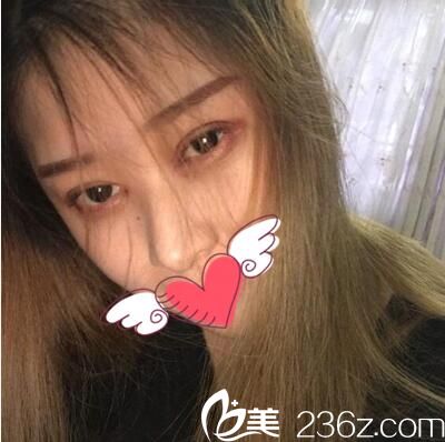 作為一名回頭客，簡單分享下我在達(dá)州雙均做雙眼皮開眼角的經(jīng)歷及術(shù)后一個月恢復(fù)圖