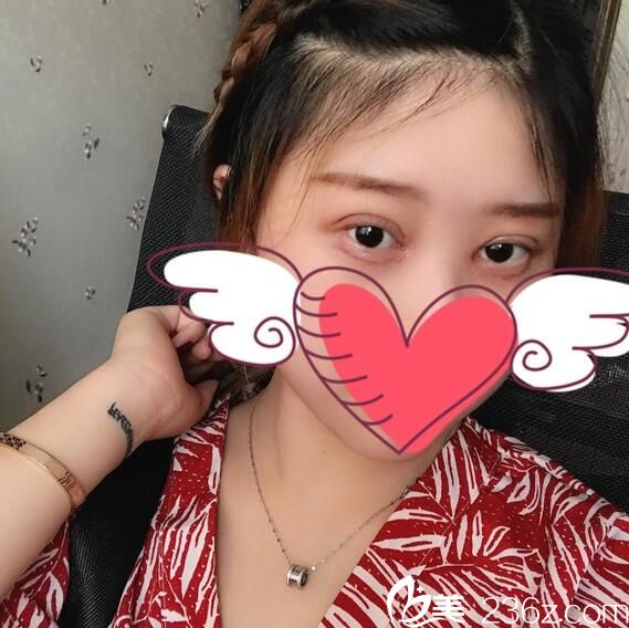 切開雙眼皮開眼角術(shù)后半個月恢復(fù)情況 切開雙眼皮開眼角術(shù)后半個月恢復(fù)情況