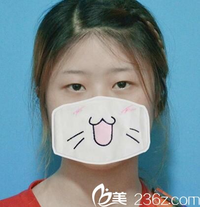 在達(dá)州雙均做雙眼皮前的照片 在達(dá)州雙均做雙眼皮前的照片