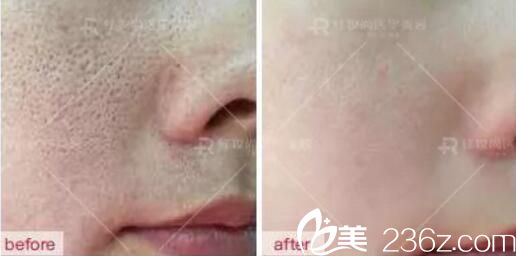 ?？诩t妝尚美顏肌真人前后效果展示