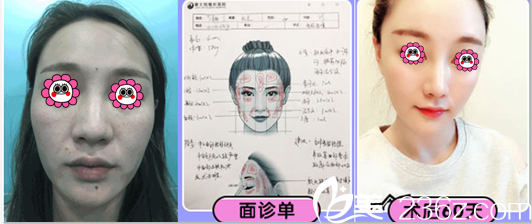 北京櫻桃自體脂肪面部填充優(yōu)惠中！單部位價格1280 元起