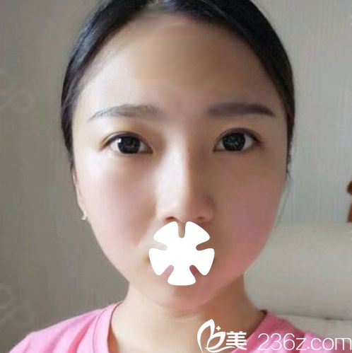 南寧哪里打瘦臉好？參考我一個(gè)月前在華美整形打瘦臉恢復(fù)效果圖