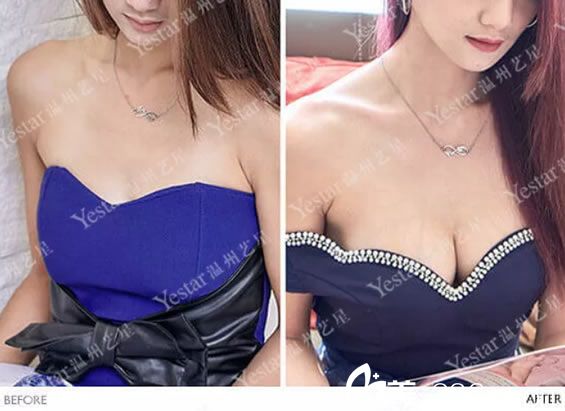 做完假體隆胸穿禮服<span style= 做完假體隆胸穿禮服<span style=