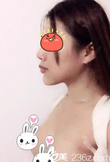 做完曼托假體隆胸5天恢復(fù)照 做完曼托假體隆胸5天恢復(fù)照