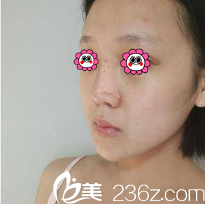 連凱峰醫(yī)生給我做假體隆鼻+耳軟骨墊鼻尖第3天樣子