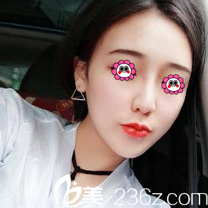 北京藝星連凱峰假體隆鼻+耳軟骨墊鼻尖案例