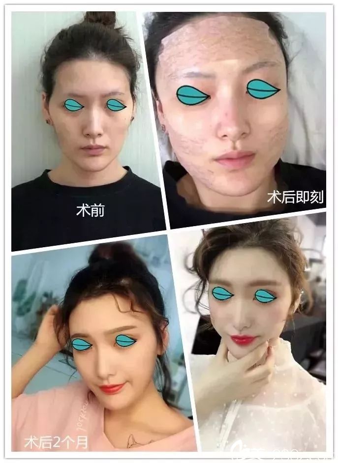 自體脂肪or線雕?無錫施爾美醫(yī)生用真人前后對比照告訴你抗衰到底該選擇哪一種