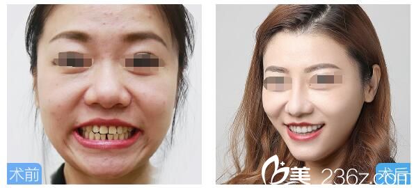 邱醫(yī)生牙齒矯正案例 邱醫(yī)生牙齒矯正案例