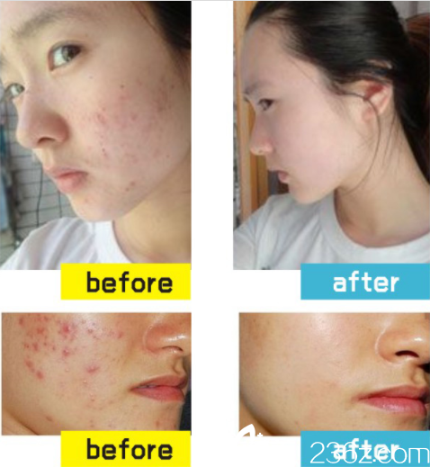 常德伊麗莎白果膚煥酸的真人案例 常德伊麗莎白果膚煥酸的真人案例