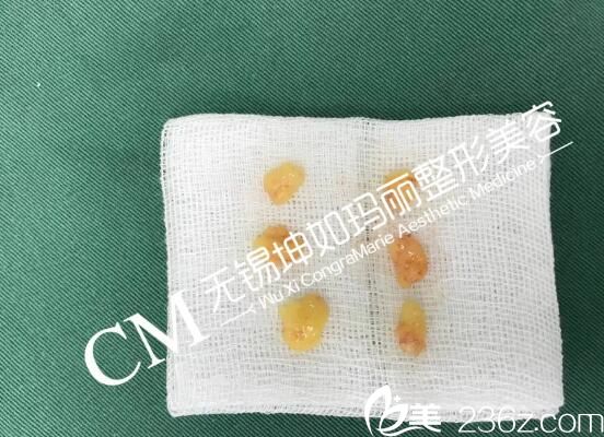 無痕祛眼袋所取出來的脂肪細(xì)胞 無痕祛眼袋所取出來的脂肪細(xì)胞