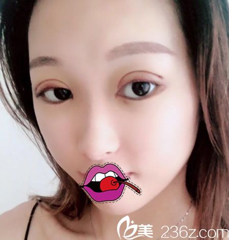 嘉興禾美剛做完雙眼皮的照片