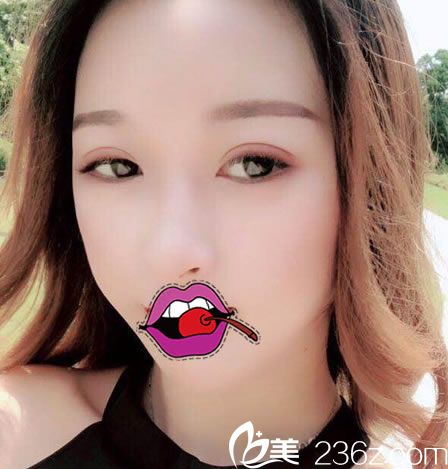 嘉興禾美整形傘光雙眼皮案例