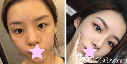 圣宜美容鼻綜合+肋軟骨隆鼻效果對(duì)比圖 圣宜美容鼻綜合+肋軟骨隆鼻效果對(duì)比圖