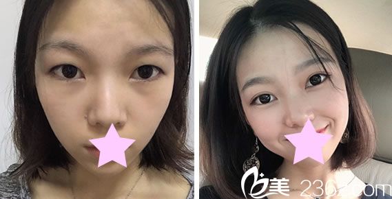 臺(tái)北圣宜眼綜合+全切雙眼皮效果對(duì)比圖 臺(tái)北圣宜眼綜合+全切雙眼皮效果對(duì)比圖