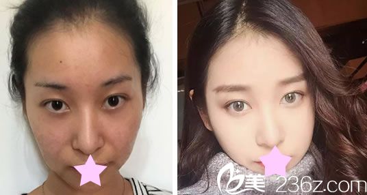 臺(tái)北圣宜美容整形面部線雕提升真人案例 臺(tái)北圣宜美容整形面部線雕提升真人案例