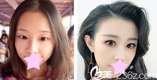 杜蕾莉陳榮峰全切雙眼皮7mm對(duì)比圖 杜蕾莉陳榮峰全切雙眼皮7mm對(duì)比圖