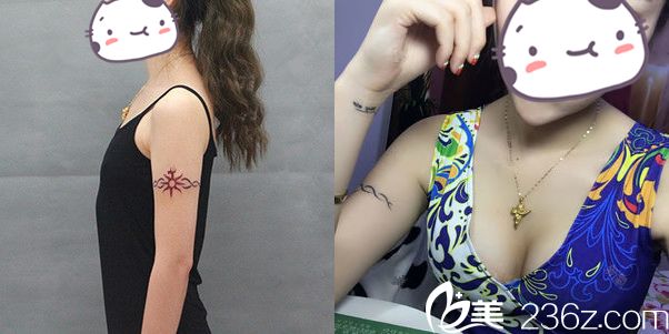 何林醫(yī)生做假體隆胸手術(shù)后對(duì)比