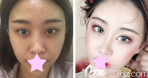 盧榮祥做面部脂肪填充效果對比圖 盧榮祥做面部脂肪填充效果對比圖