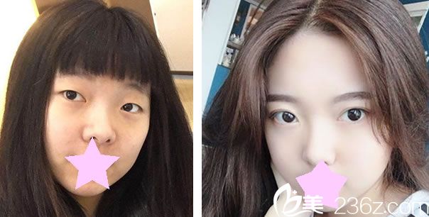 臺北楷鈞時尚美容診所盧榮祥做全切雙眼皮效果對比圖 臺北楷鈞時尚美容診所盧榮祥做全切雙眼皮效果對比圖