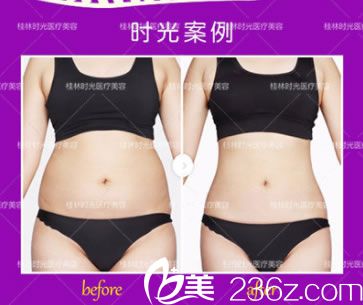 桂林時(shí)光整形腰腹部環(huán)形吸脂塑形案例效果
