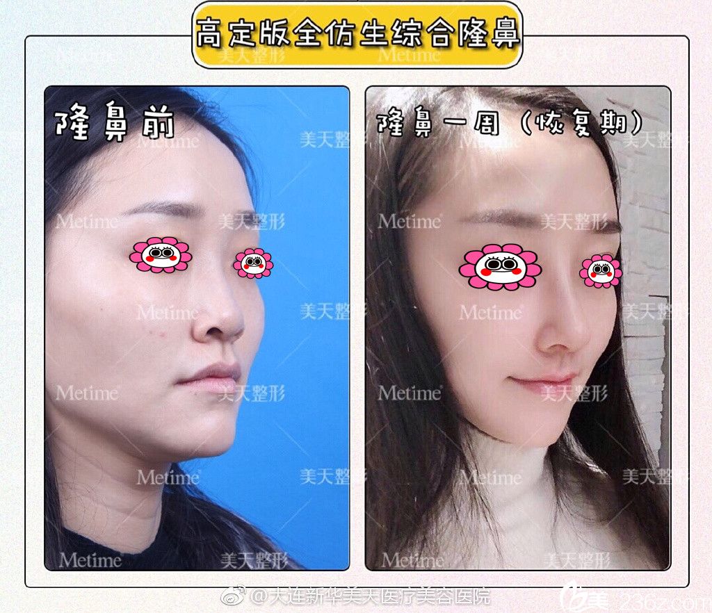 大連新華美天隆鼻前后對(duì)比圖