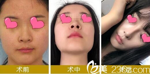 華美悅美整形醫(yī)院隆鼻前后對(duì)比