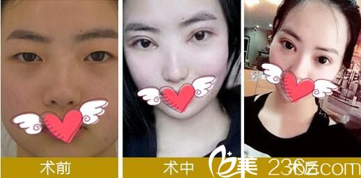 華美悅美整形雙眼皮手術(shù)案例